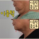 말턱고개 | 이중턱지방흡입후기, 살 빼도 사라지지 않는 투턱 어떻게!
