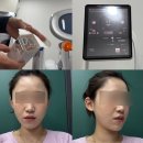 영등에너지 | 당산역피부과 덴서티알파팁 슈링크 후기 (유지기간, 효과)