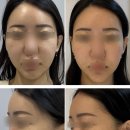 에스와이바른피부과의원 | 시흥은행동피부과 슈링크 전후비교 효과 차이 통증 후기