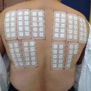 더한스 | 손발바닥에 생기는 작은 물집, 한포진(pompholyx)이란?