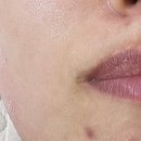 노원우태하피부과의원 | [노원피부과] 교정 후 생긴 깊은 입가 선주름, 맑을아의원에서 콜라겐주사+자가진피재생술로 채운...