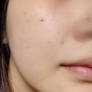 마이스킨피부과의원 | 내돈내산 신사피부과 에이브의원 스킨부스터 셀르디엠 후기