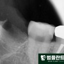 범플란트치과의원 네이버블로그