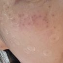 코미인의원 | [금천]미앤영의원 얼굴 점 제거 2차 관리중