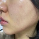 쎄리스킨케어 | EGF 앰플 울쎄리온 MTS홈케어후기