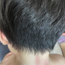 코젤병원 | 돌아기 발진 두드러기 알러지 면연력 코젤병원 알러지검사 후기