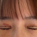 논현어린이집 | 논현역 쌍수 전후 내돈내산 후기 재수술3번째[절개,뒤밑트임]