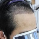 남성 전두부 엠자 비절개 모발이식 3500모 1년 최종경과 후기! -모더함의원-
