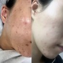 [좁쌀 여드름 관리] 동탄 에스테티움 내돈내산 후기 (할인 방법)
