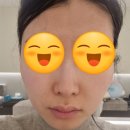 유앤아이피부과 클리어코코 5회차 슈링크 유니버스 3회차 포텐자2회차 쥬베룩1회차 솔직 후기 및 효과