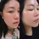 생성공간 | [부산피부과추천] 쥬베룩볼륨후기,옆볼꺼짐,내돈내산 후기