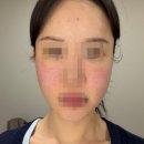 이*진2 | 청담 피부과 :: 줄기세포 시술 1주차 찐 후기