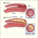 (혐) 경동맥 내막 절제술.gif 이미지