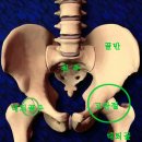 골반변형 고관절교정 다리길이 차이 이소가이요법 이미지