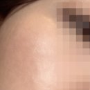 피부 여드름흔적 레이저 치료, 에어토닝 등 4회 후기(내돈내산)