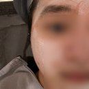 곰돌이 PC | 천안 여드름 한의원 여드름 전문 한의원에서 정안 치료 여드름 흉터 맞춤치료 후기