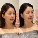 골드스퀘어치과기공소 | 부산 에스테틱 추천 ㅣ끌리메 센텀 윤곽관리 리얼 후기 (1회차 전후 비교)