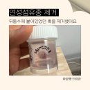 연성어린이집 | [머리에 혹 제거 후기] 연성 섬유종 치료