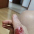 냉동치료로 사마귀 죽이기 (징그러움주의)