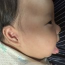 (주)한경 이-텍 | D+67일, 블로그 재개장 및 아기 스킨텍(쥐젖) 제거 후기