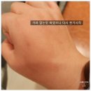 열린프라자약국 | [벌 쏘였을 때 응급처치 주의사항] 손등 벌 쏘임 붓기 가려움 증상 / 화성 봉담 성모피부과 진료 후기