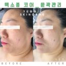 순천 브이라인 턱살 없애는 윤곽관리 전문 예쁘제이뷰티