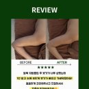 더새로이의원 | 잠실팔뚝사후관리ㅣ팔뚝 지흡 후 단단하고 터질 것 같은 붓기, 단 1회 만에 가벼워진 비결✨
