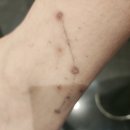 (내돈내산)타투 제거 수술 및 레이저 제거 후기(2년 경과)
