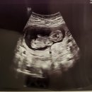 (구)보건소사거리2(하나은행앞) | 2026년 3월 소파술 후 재임신 13주차 기록, 가벼운 교통사고 후기