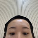 처인 | 용인 처인구 편평사마귀 제거 후기 '내돈내산' 시술/통증/회복 과정 총정리