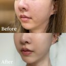 송피부과의원 | 이브타이탄 중안부 리프팅 축소 효과 가격 장단점 안산 피부과 추천 근육층 케어 얼굴탄력시술 후기~!