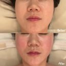 서면 윤곽관리 제이민스킨케어 얼굴라인 변화 후기
