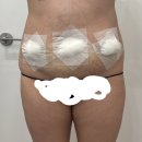 가오한의원 | 복부 러브핸들 람스 당일 후기 출산 후 다이어트 (통증, 붓기)