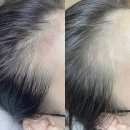 선헤어라인 이미지