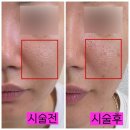 선명열축사 | 여드름패인흉터치료 성지 곰보피부 셀라스 아인셀 레이저 가격 후기