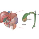 급성 담낭염 (Acute cholecystitis) 이미지