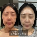 천호피부관리 얼굴축소 관리 솔직 후기 가인미가 천호에스테틱