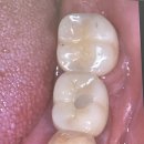 (주)오스템 | 강남역 뉴엔치과 오스템임플란트 내돈내산