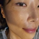 차한의원 | 광주 한의원 광천동 흉터전문한의원 모공 흉터치료 2회차 후기