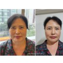 비몽사몽 | 줄기세포주사후기, 티타늄리프팅도 함께한 내돈내산(+엄마선물추천)