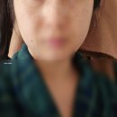 압구정 루비레이저 내돈내산 솔직후기 추천 or 비추천