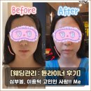 홍대 피부과 :: 튠라이너 리프팅 솔직 후기(전후,통증,과정 포함)