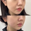 파워 디렉터 & 유튜브 관리 | 인천 구월동피부과 추천 / 볼뉴머리프팅 600샷 시술 후기!(전후사진, 통증)