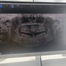 애지치과의원 | 개쫄보가 사랑니 4개 뽑은 썰