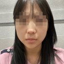 보람외과의원 | 압구정성형외과 매부리넓은코성형 이젠 콤플렉스에서 굿바이!