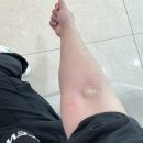 열린메디의원 | 창원난임 시험관 엘르메디여성의원 PGT통과배아 이식 당일날 후기