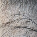 에이원헤어라인 이미지