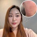 얼굴 알라딘 필링 후기, 각질관리방법 수원피부관리 차오름미