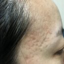 대구 관자놀이 여드름흉터 한의원에서 새살침12회 대박 후기 / 내돈내산