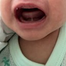 오산 소아과추천_생후 36일차 아기 설소대 시술후기